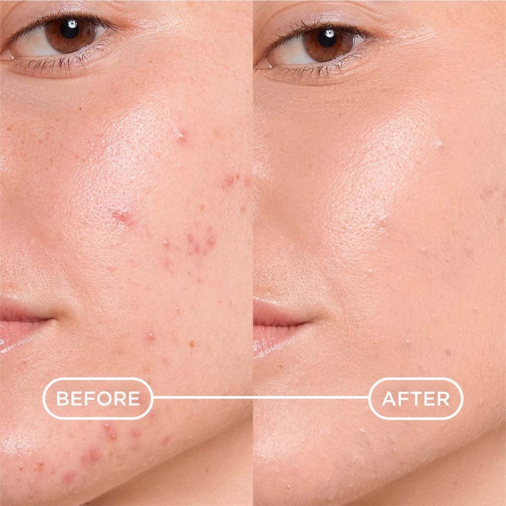 Kerato+ Cover - Instruction for use